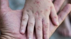 Scabie: patogen, simptome și tratament